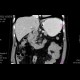 Tumour of duodenum: CT - Computed tomography